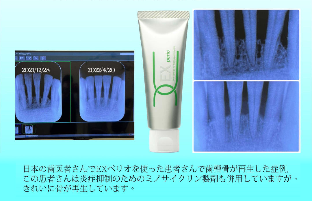 YOZAI-牙周凝露-來自日本牙醫的齒槽骨再生案例