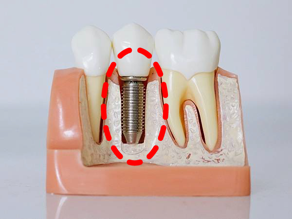 植體周圍炎是因為植牙後齒槽骨縫隙細菌感染所引起